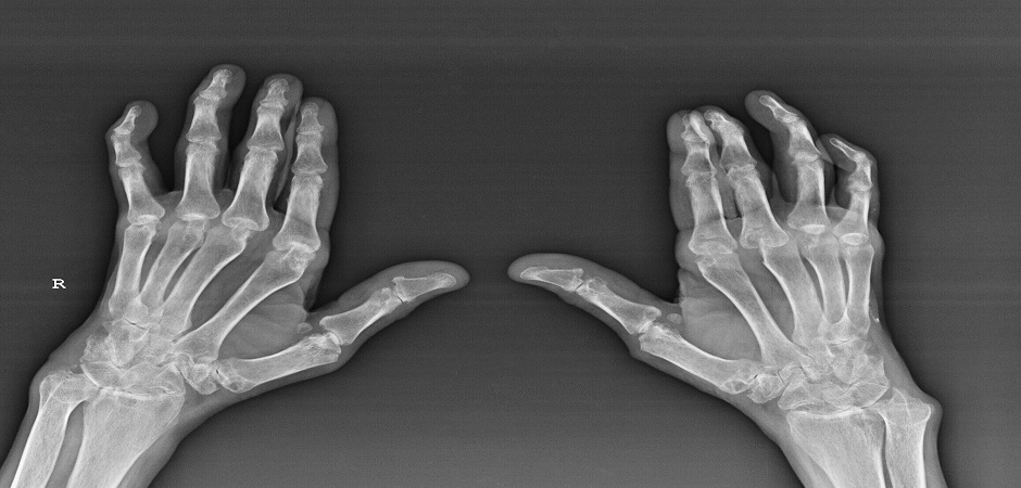 Реактивный полиартрит: симптомы и лечение в Москве